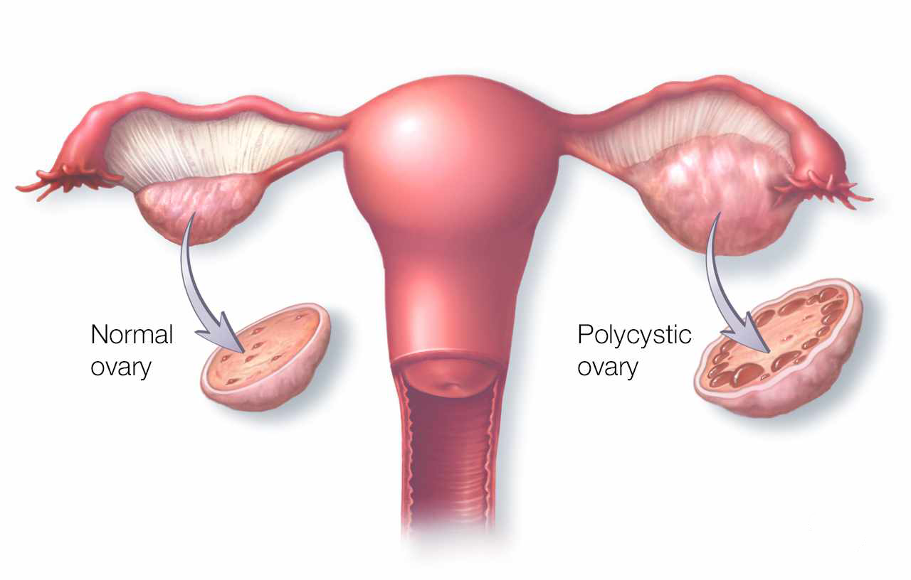poli systic ovary syndrome