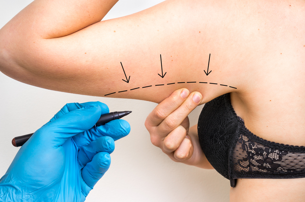 Arm Liposuction