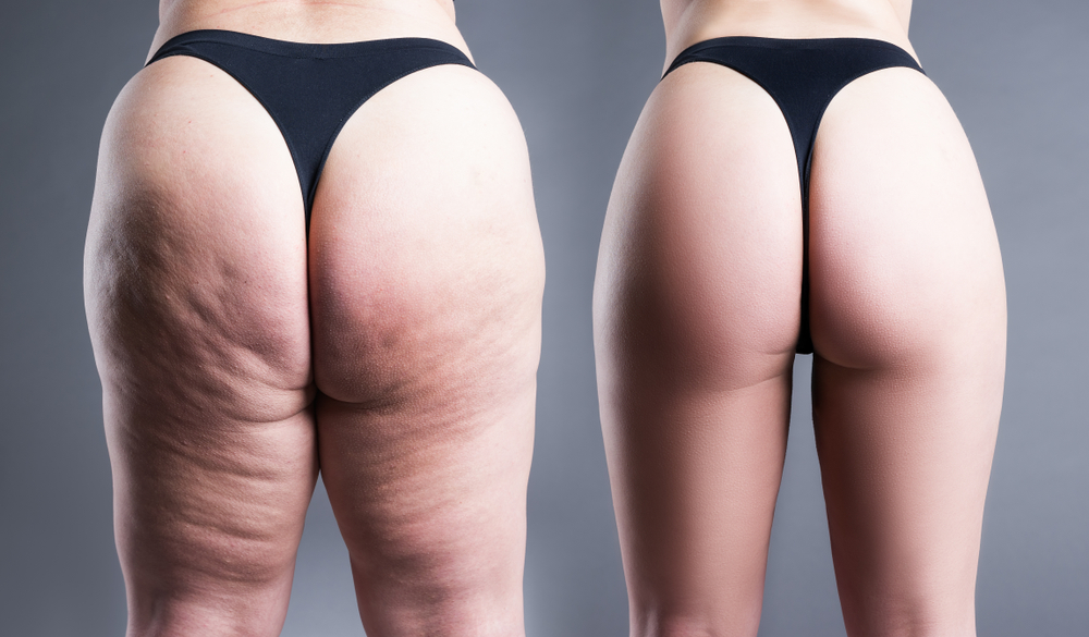 Butt Liposuction