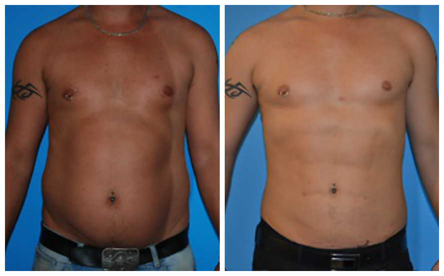 Lipo Before and After Male