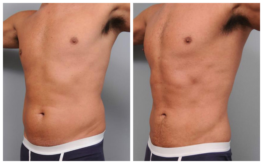 Liposuction Before and After Male