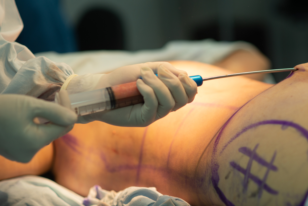 Liposuction using Syringe