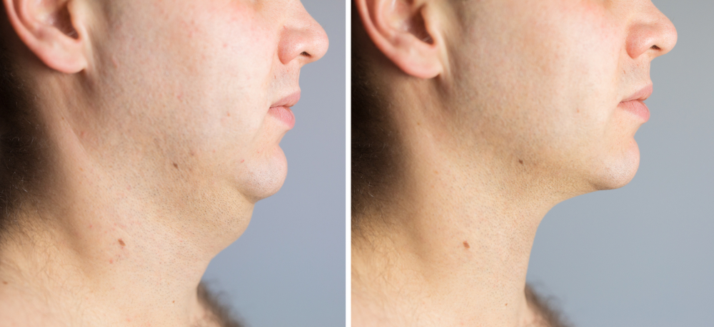 Neck Liposuction