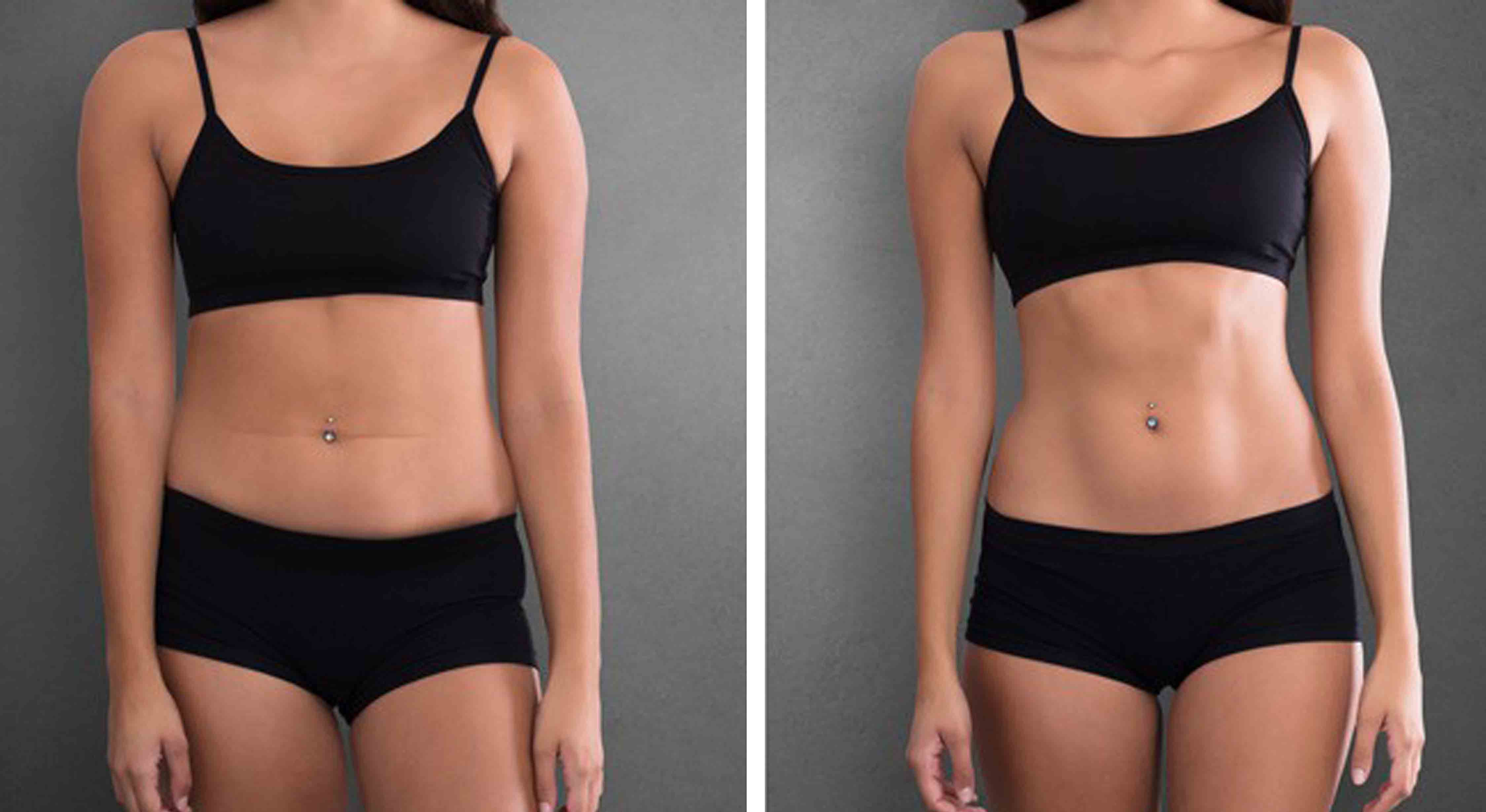lipo before and after female