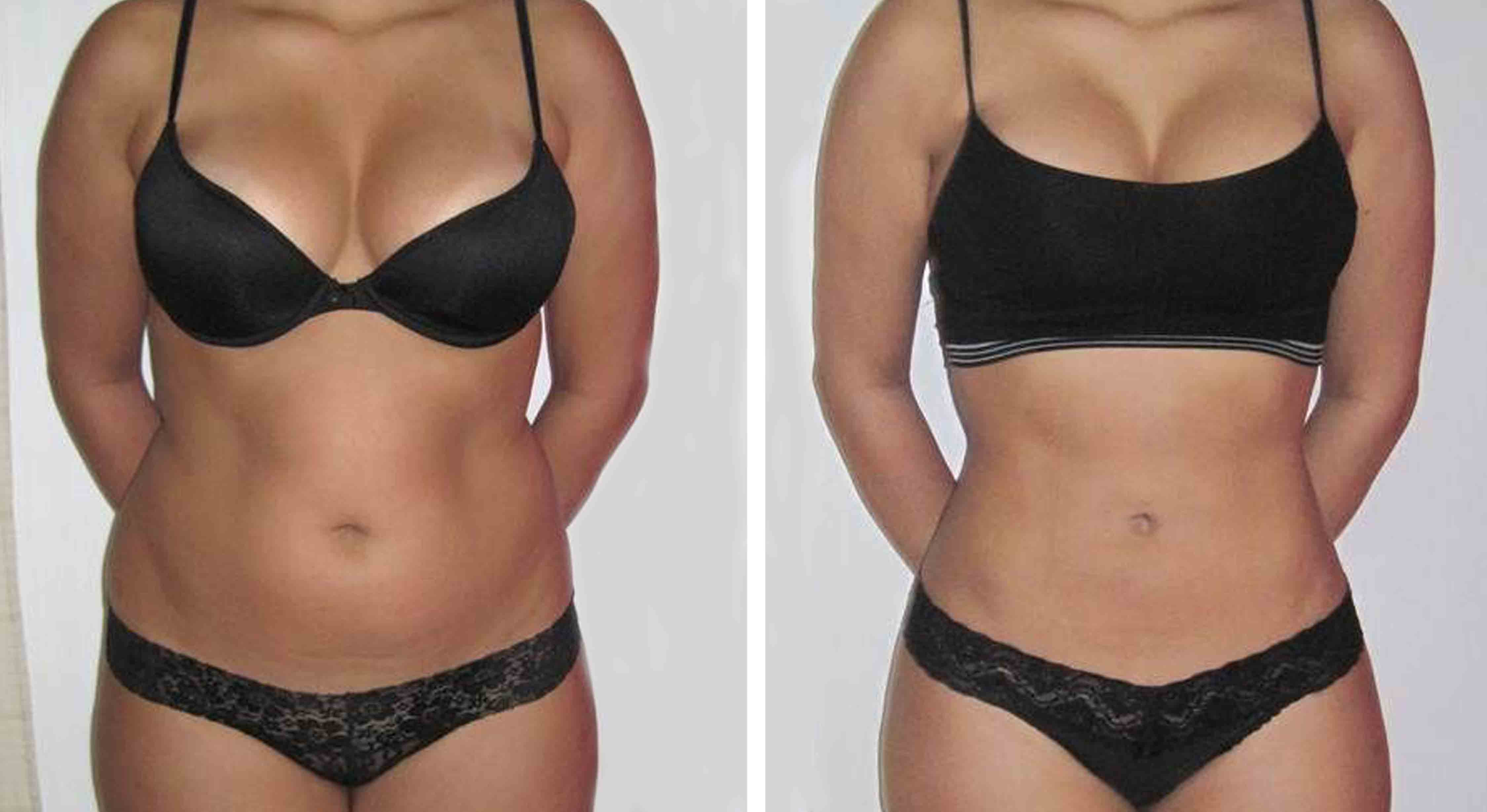 liposuction before and after woman