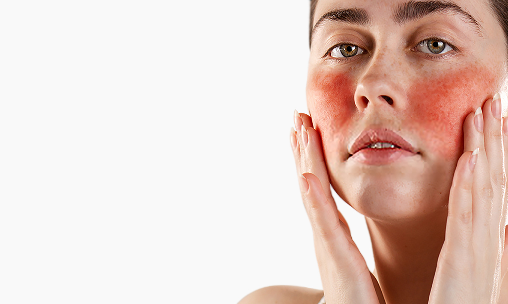 Rosacea