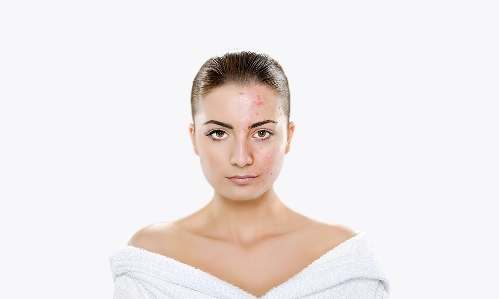 acne breakout 