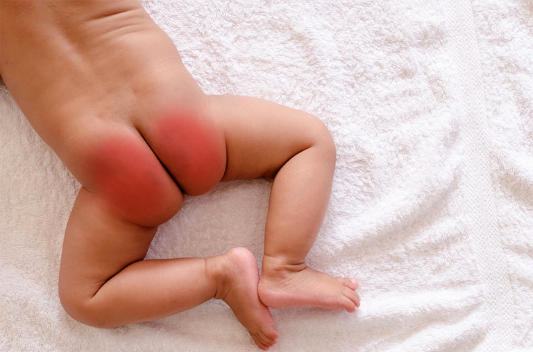 What are the Causes of Diaper Rash