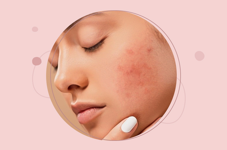 What Causes And Worsens Dry Skin