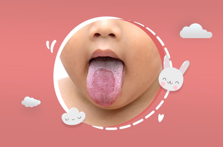 baby tongue yeast infection