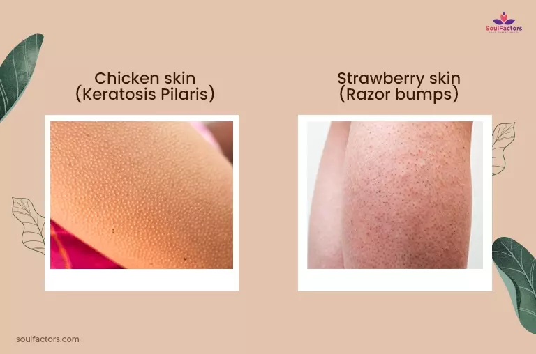 Chicken Skin Vs Strawberry Skin