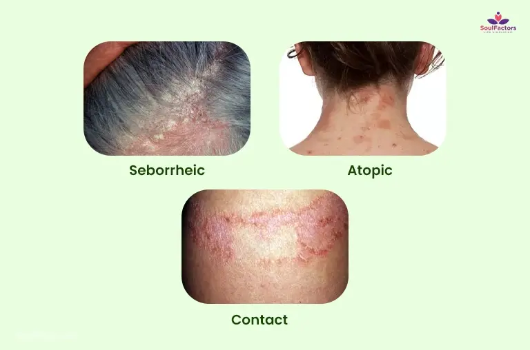 Three Types Of Eczema That Affect The Scalp