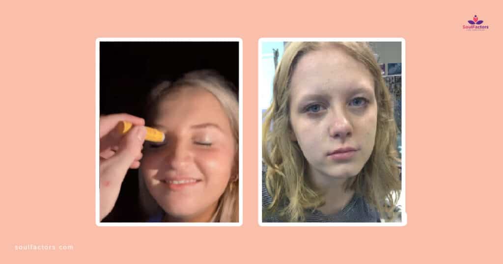 Tik Tok Trend "Beezin" With Burt's Bees Lip Balm Harmful