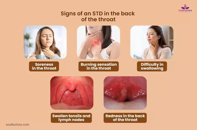 What Are The Symptoms Of STD In The Throat?