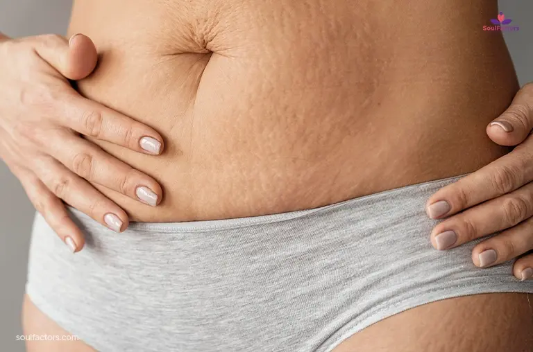 Postpartum Skincare: Stretch marks
