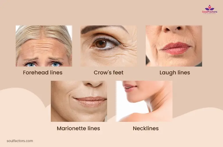 Types Of Dehydration Lines On The Forehead