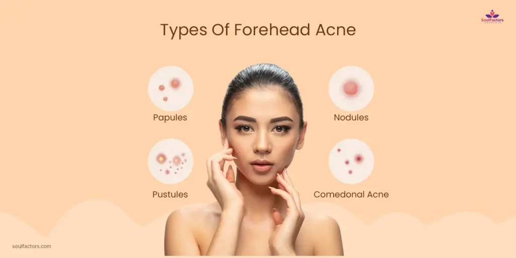 Types Of Forehead Acne 