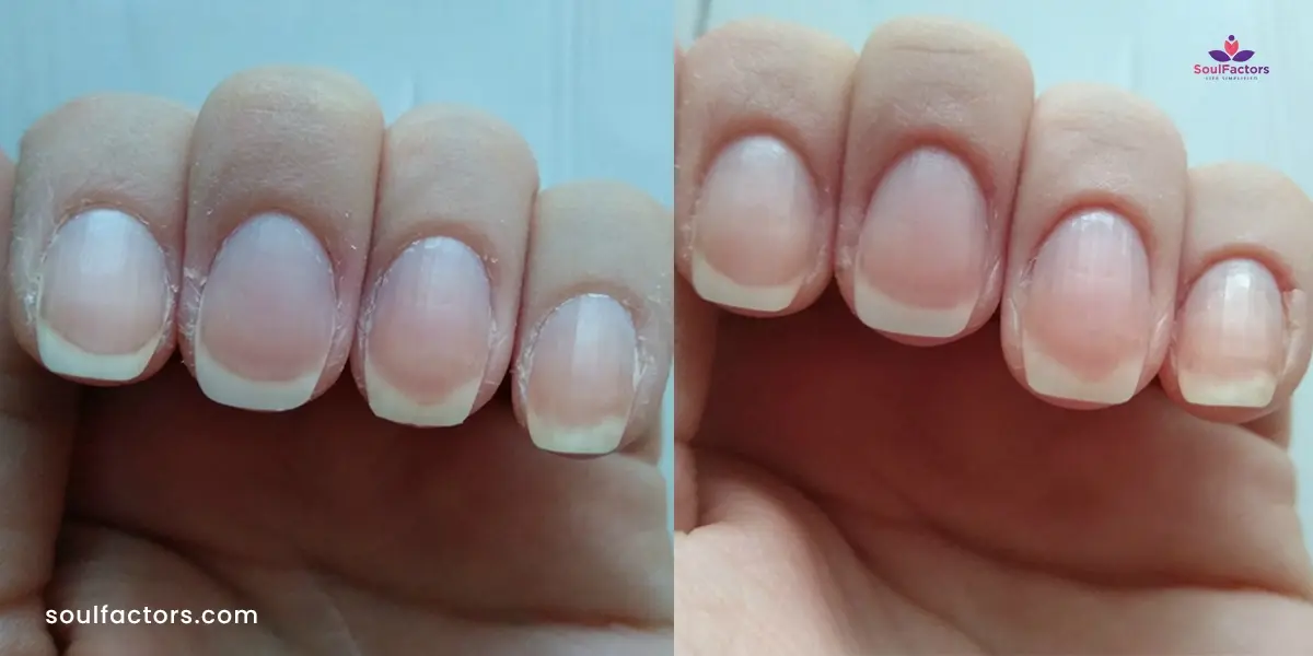 Troubled By Skin Around Nails Peeling? -  Discover Effective Solutions