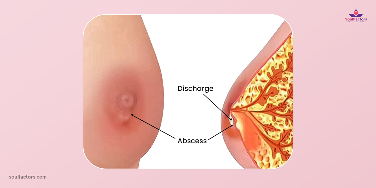 Abscesses And Clogged Glands In And Around Nipples
