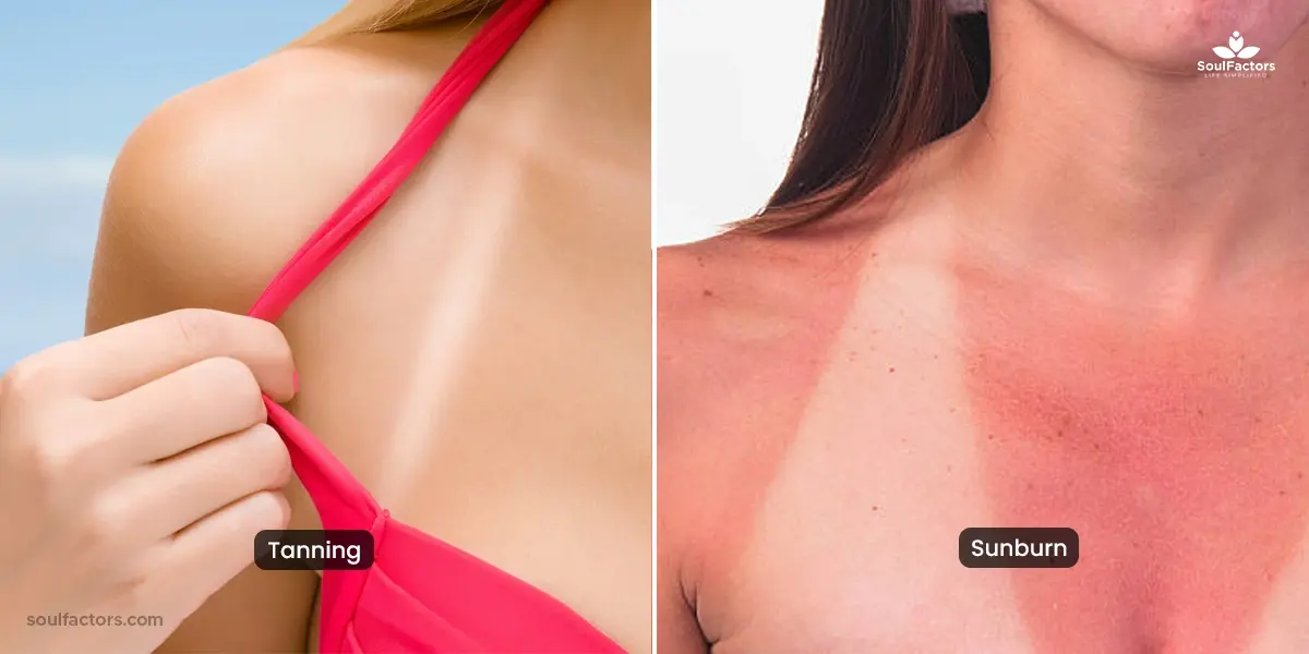 tanning vs. Sunburn 