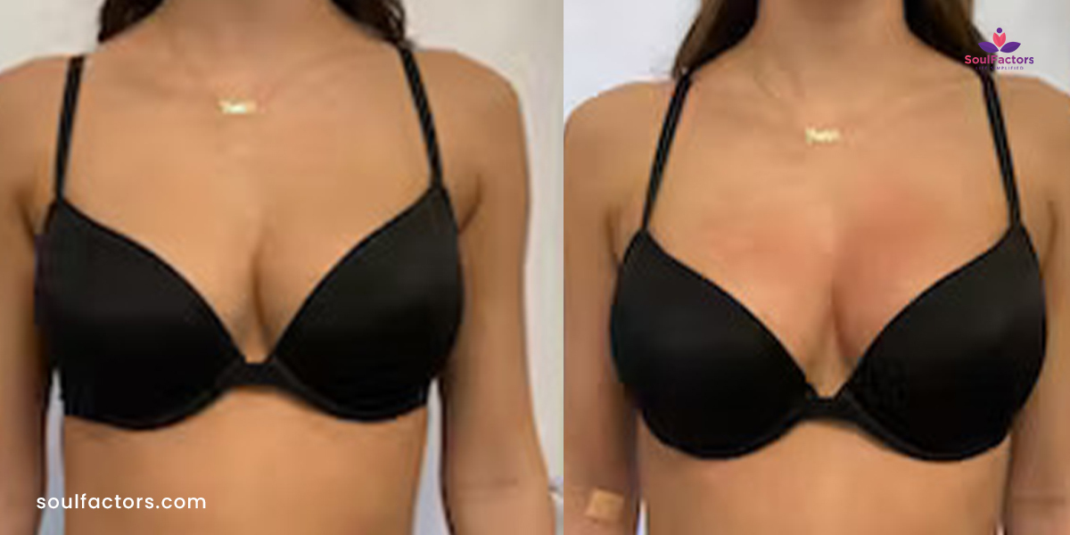 bodytite breast lift cost