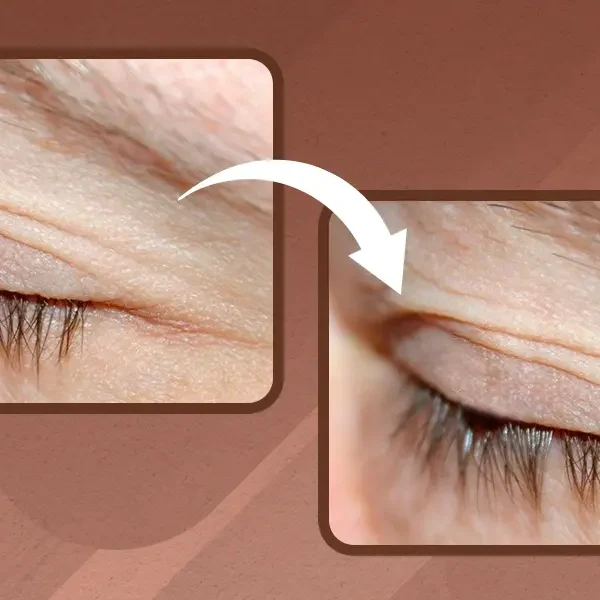 How to Remove Skin Tag on Eyelid