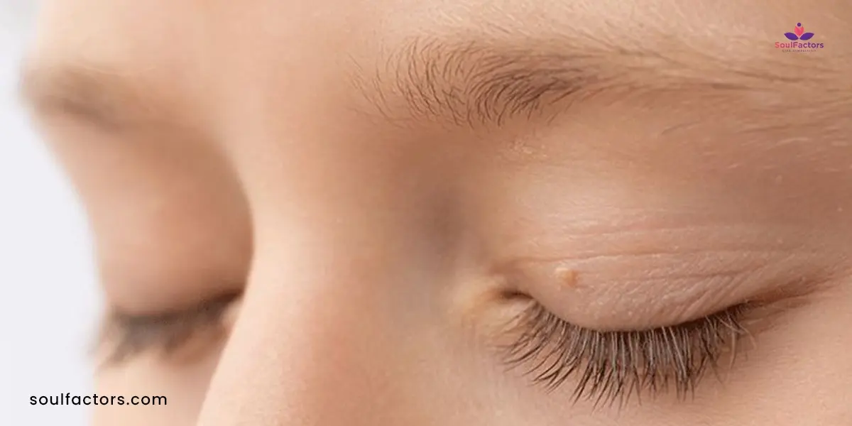 What Causes Skin Tags On Eyelids?