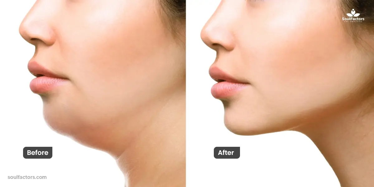 neck fat surgery before and after