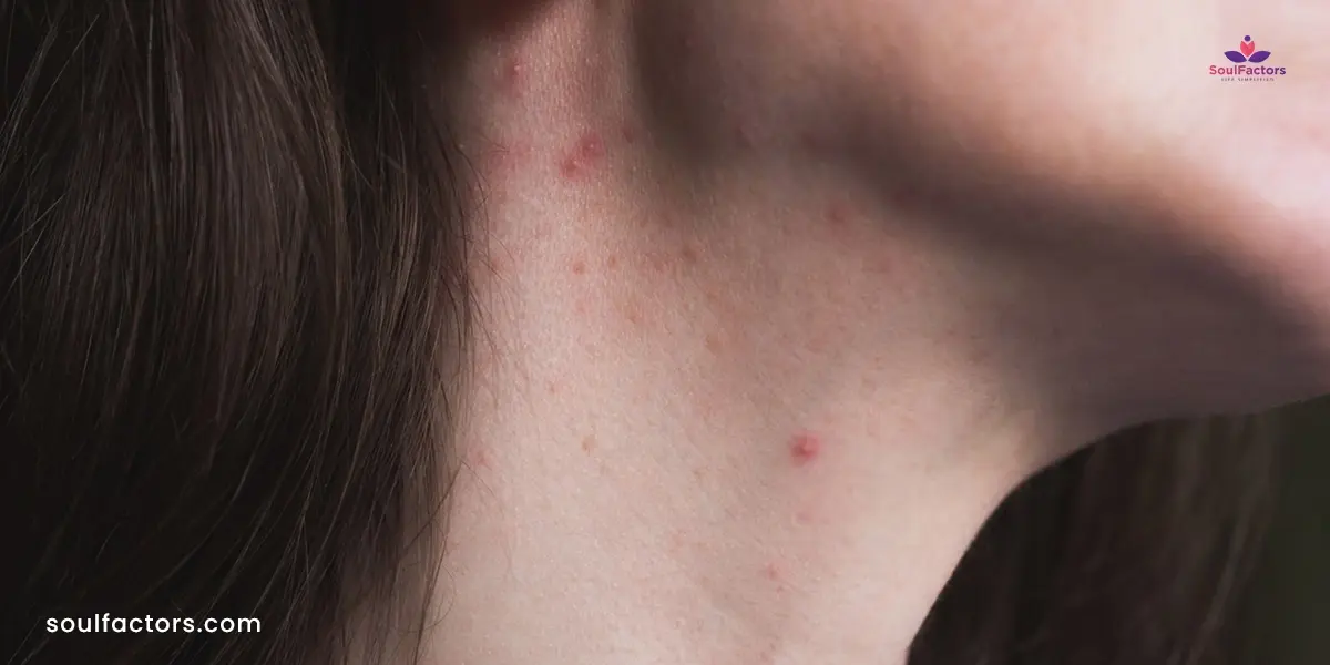 hormonal neck acne