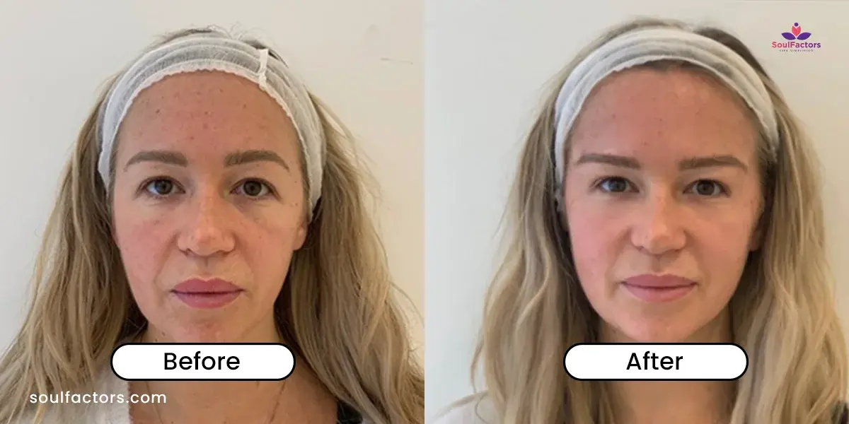 Fox Eye Thread Lift Before And After