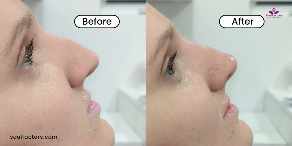 Nose Thread Lift Before And After