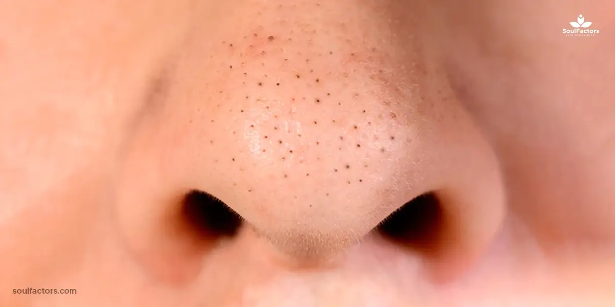 How To Close Pores On Nose Naturally