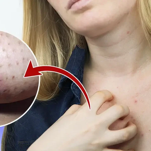 How To Get Rid Of Clogged Pores Under Breasts