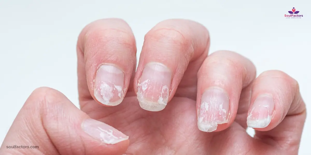 Weak And Damaged Nails