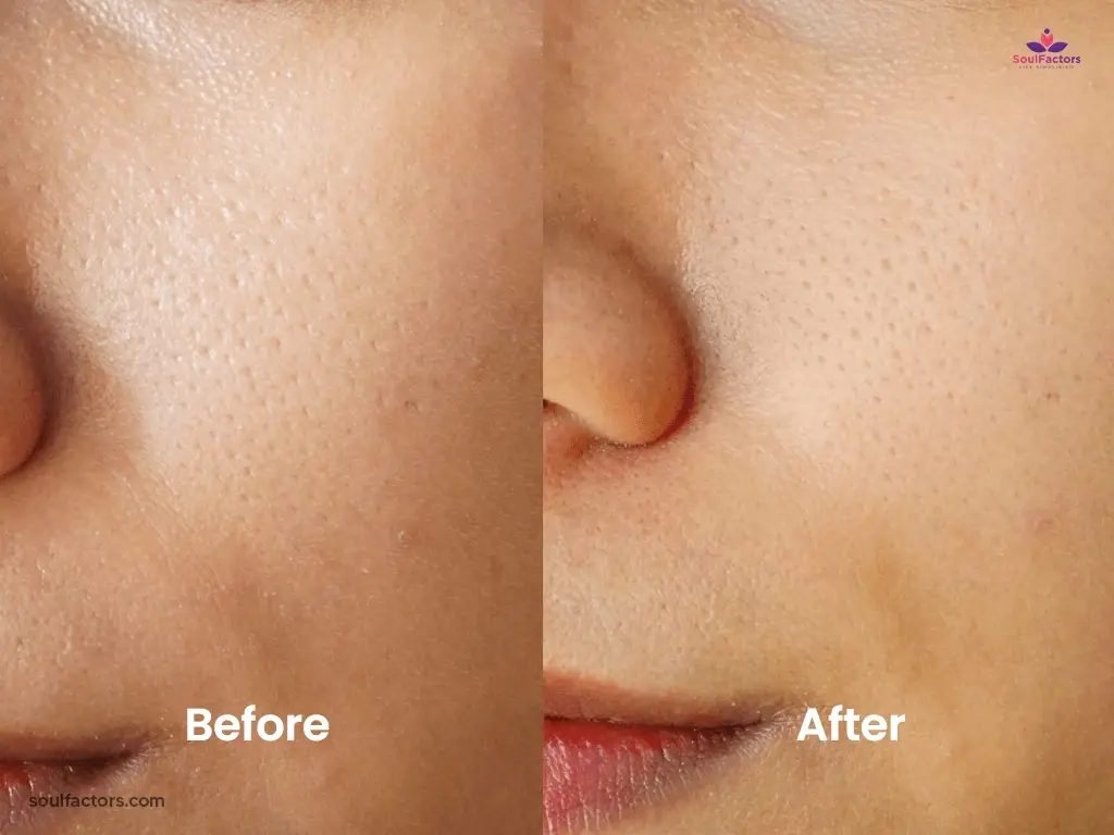mediheal toner pad before and after