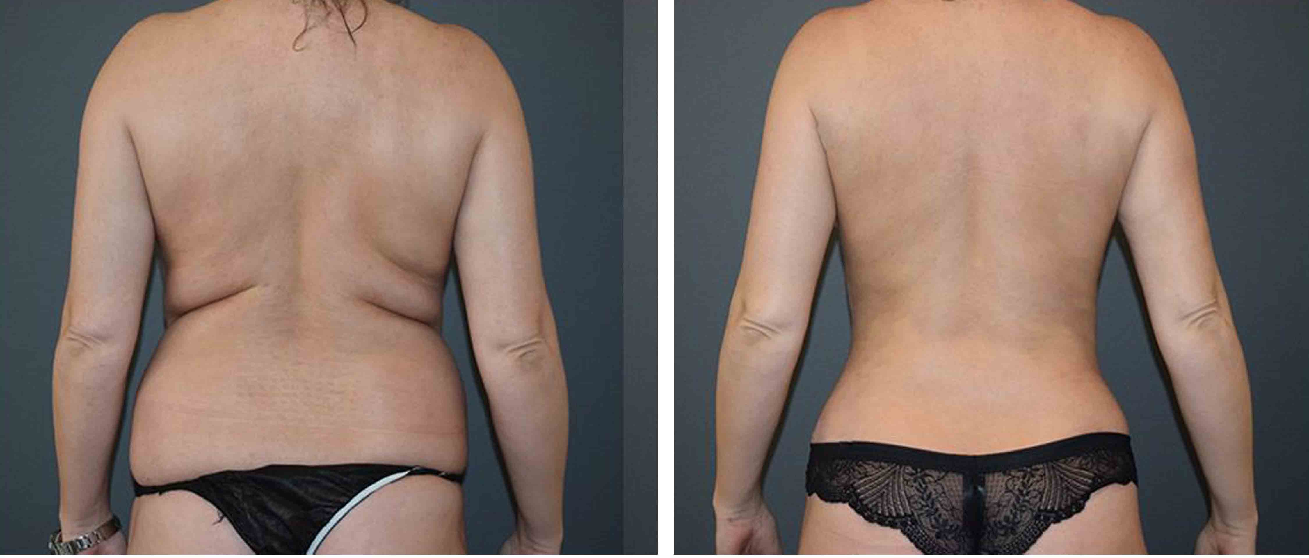 Liposuction before and After Love handles