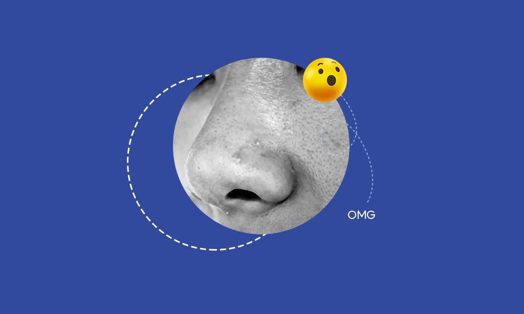 Keratin Plugs And Sebum Plugs What You Should Know?