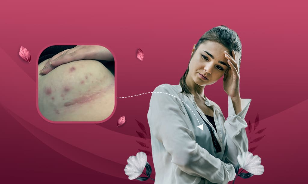 Underboob Rash Causes And Treatment For Sensations